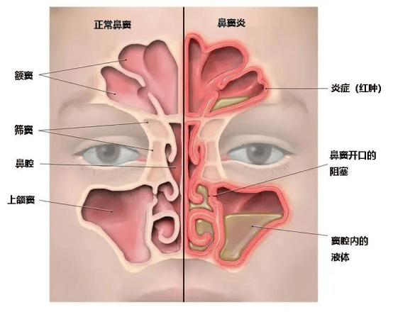 孩子流涕,打喷嚏,咳嗽,到底是感冒,鼻窦炎还是过敏性鼻炎?