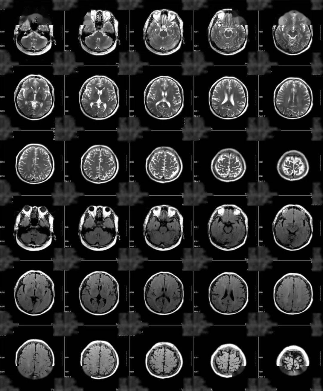 头颅mri mra示右侧大脑中动脉m2段可见一动脉瘤,直径约0
