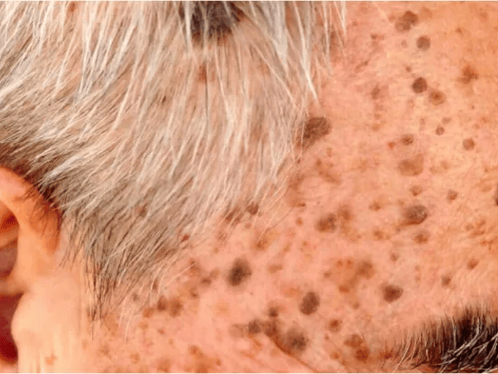 脂溢性角化病（老年斑）寻常疣、扁平疣、丝状疣等专家提醒接受二氧化碳