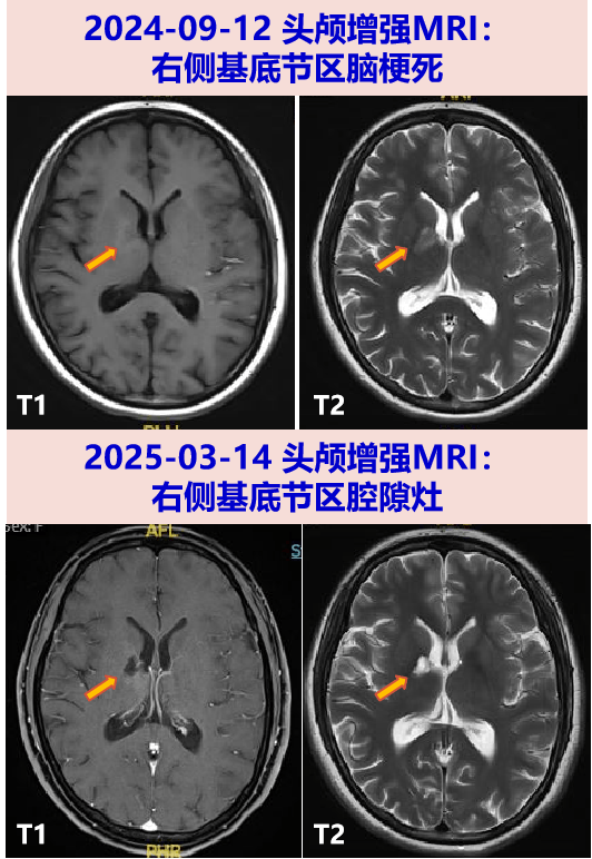 探案丨发热头痛,一探究竟