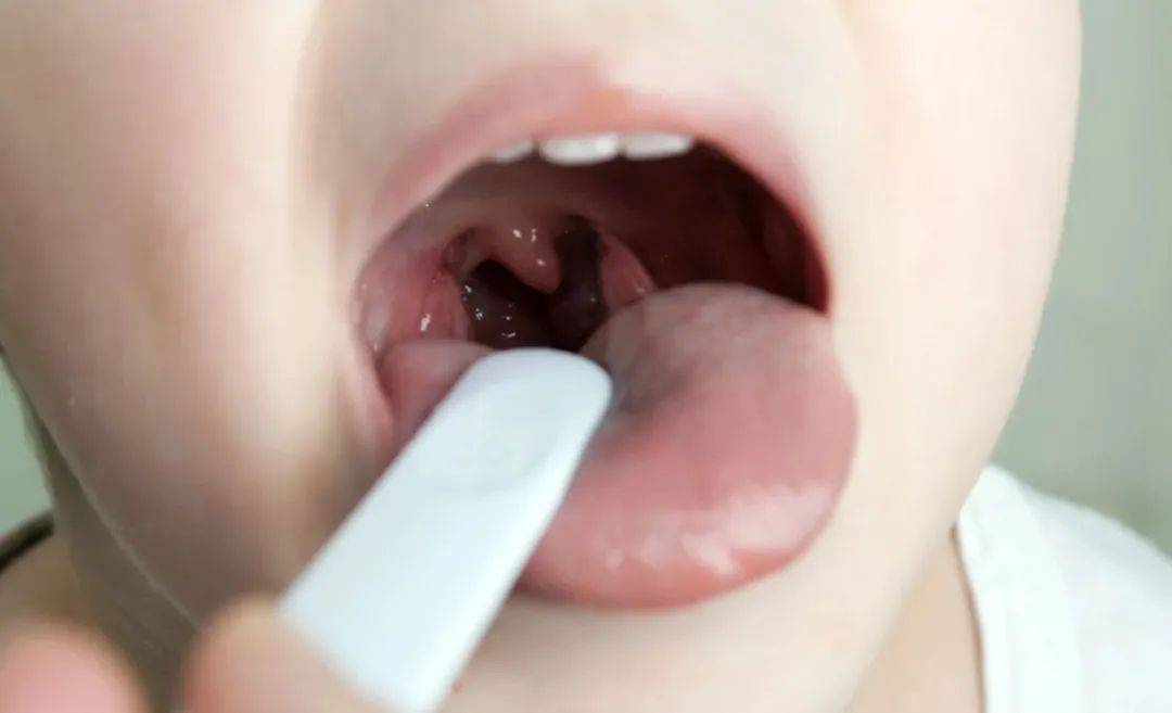 扁桃体反复发炎,又不想一刀两断?老祖宗传下来的"新"方法可以一试
