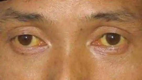 皮肤小毛病竟暗示大肾脏问题，你知道吗？