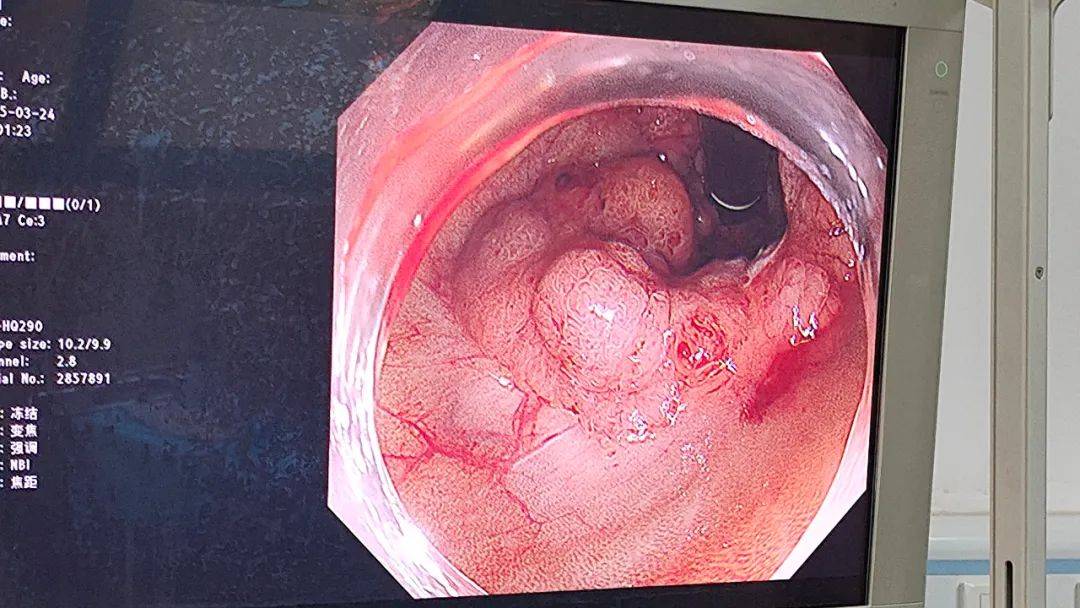 —我院开展经肠镜下自然腔道微创绒毛管状腺瘤完整切除