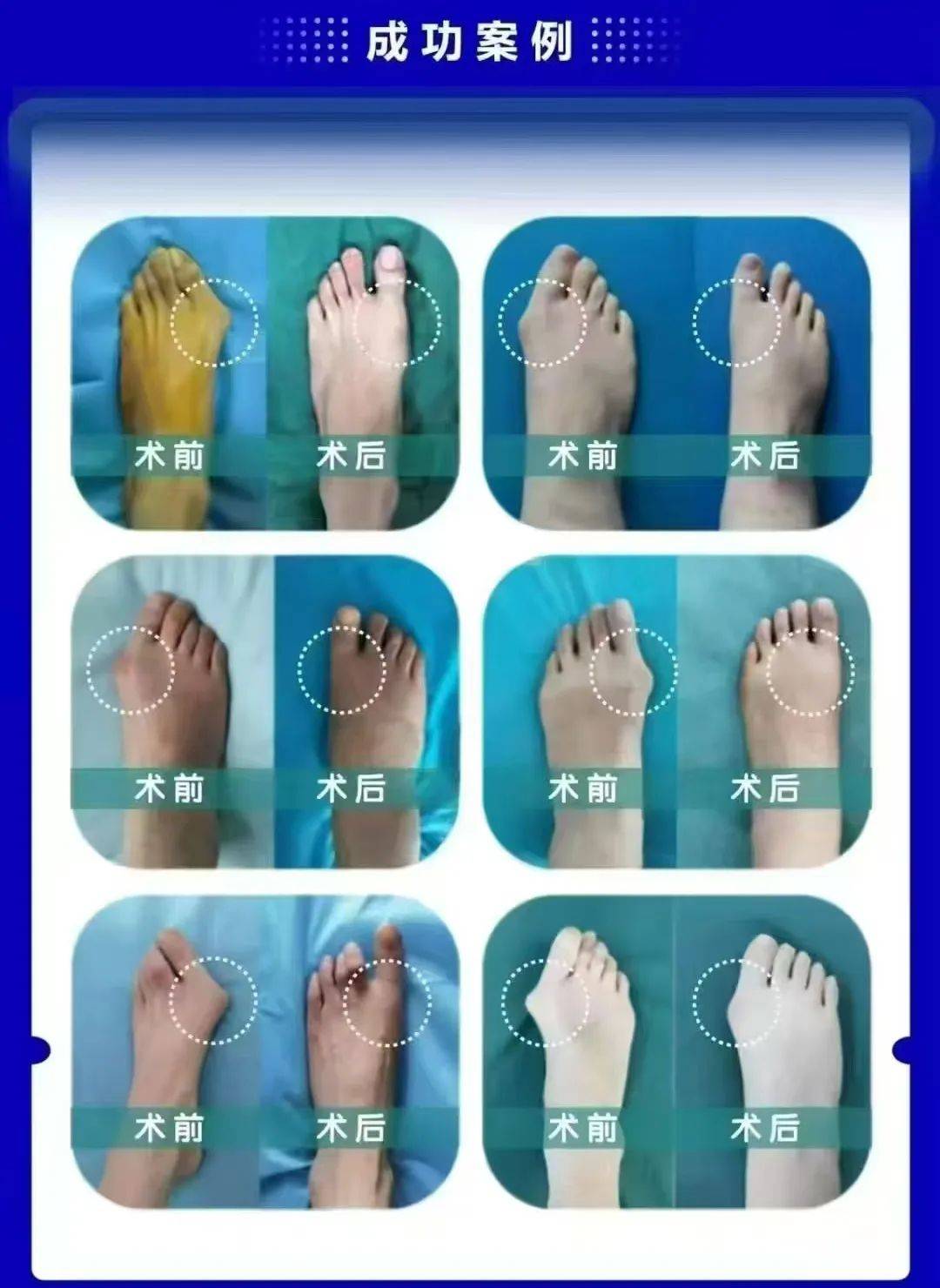 𧿹外翻,俗称"大脚趾歪斜",是