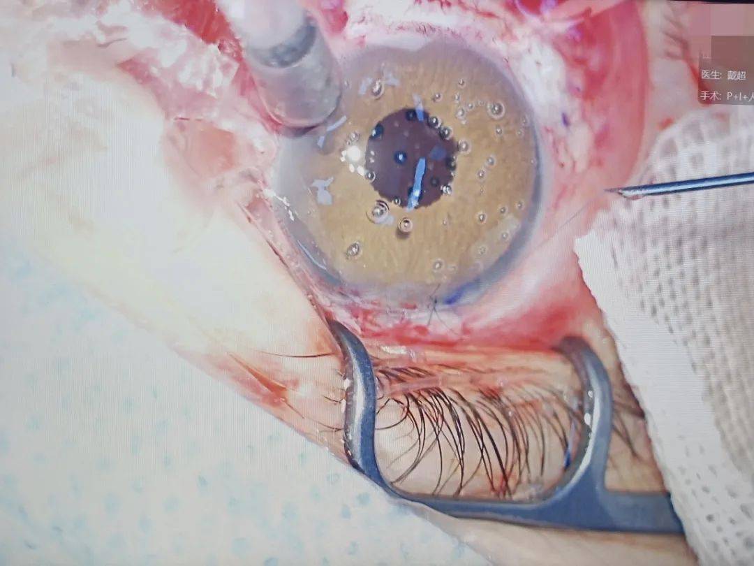 中西部首例人工虹膜移植术成功实施