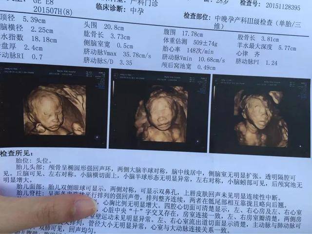 检查_胎儿_超声