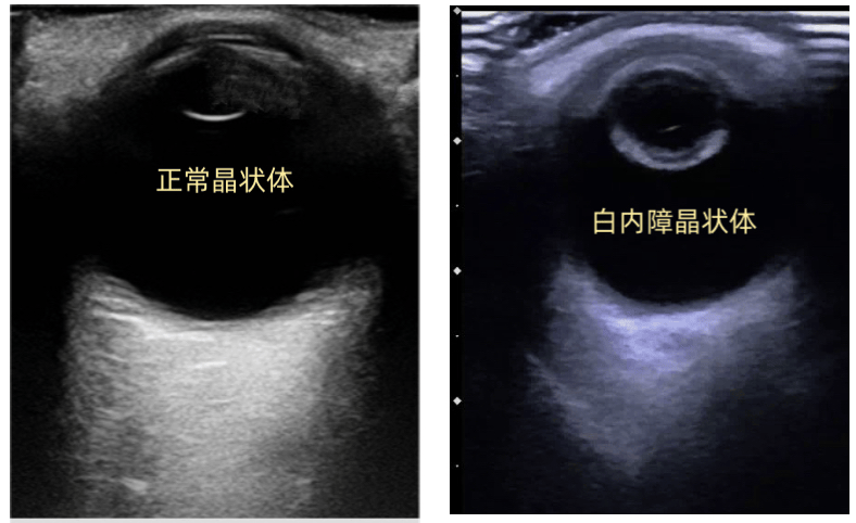 眼科b超图谱汇总
