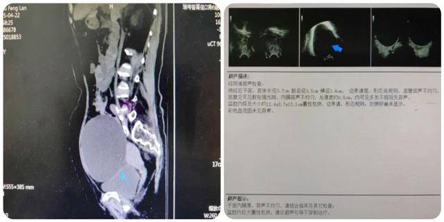 西安市第一医院成功救治高龄危重卵巢囊肿蒂扭转患者