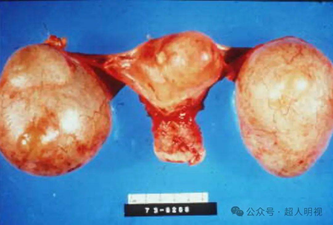 形态:囊性(囊腺瘤),囊实性