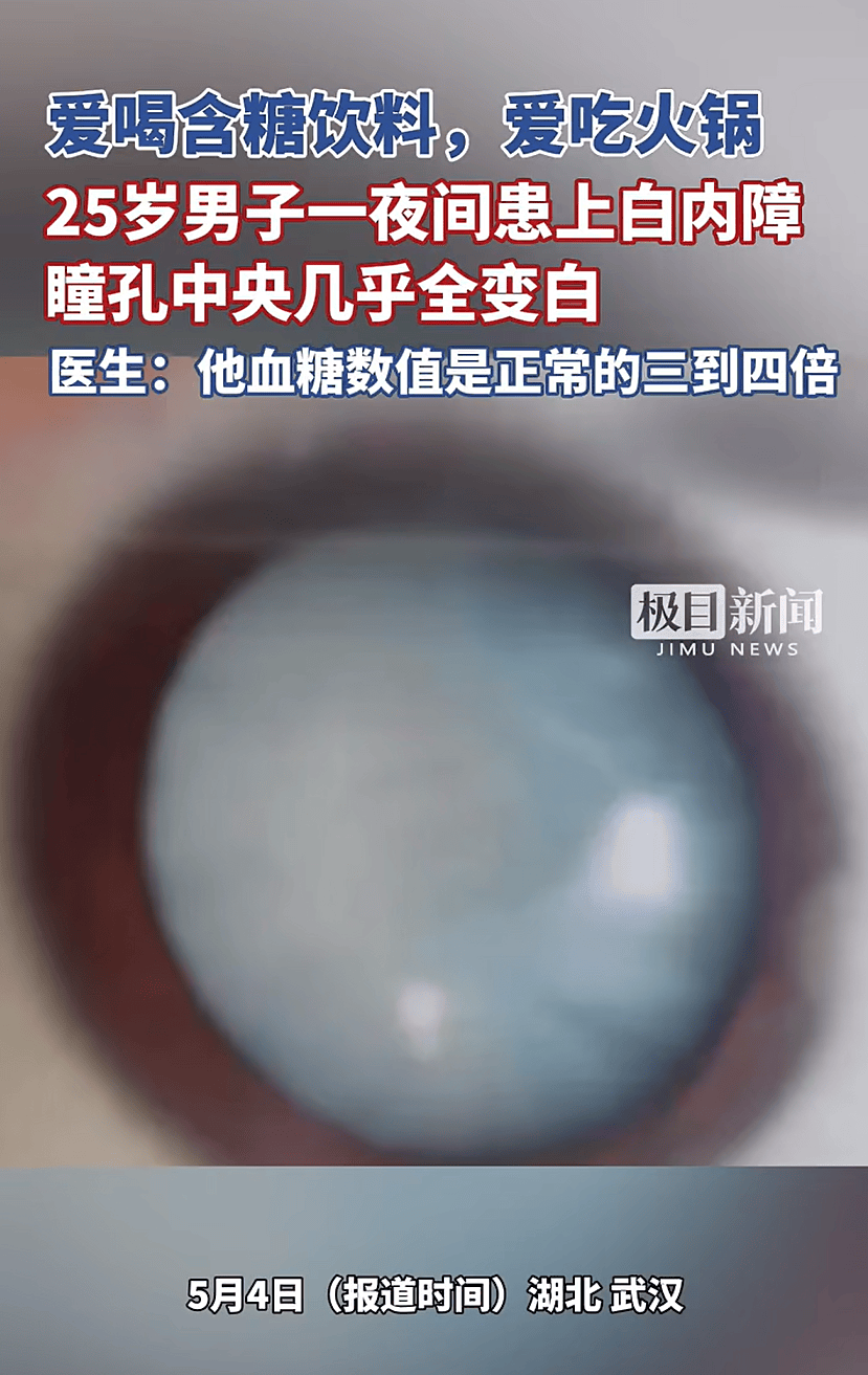 25岁小伙双眼瞳孔一夜之间全白!这些习惯很多人都有