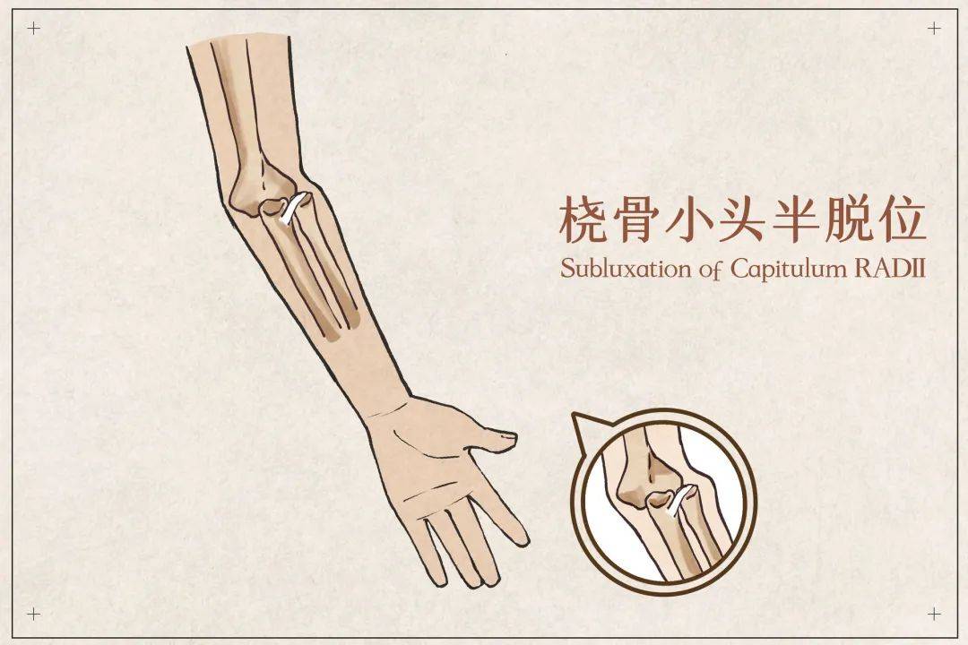 「牽拉肘」:小小孩的莫名之痛! - 求真百科