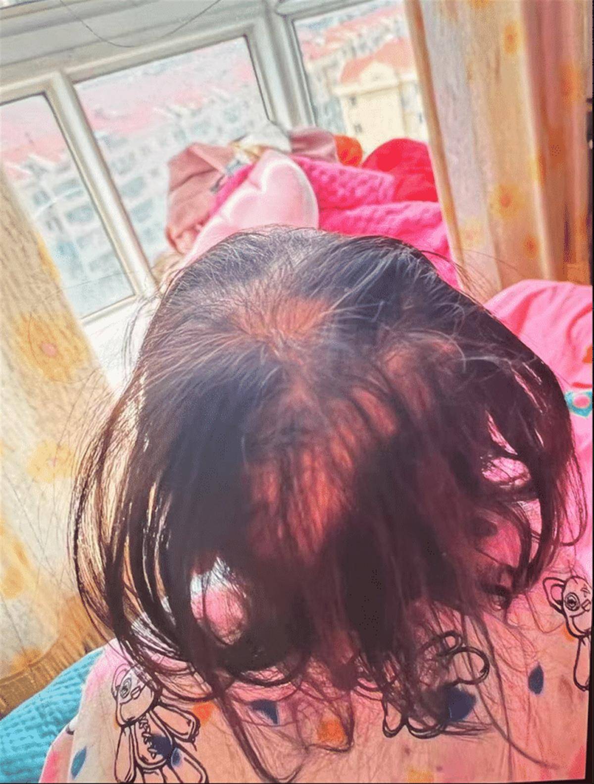 一名3岁女孩因脱发而被诊断出患有慢性thal虫中毒