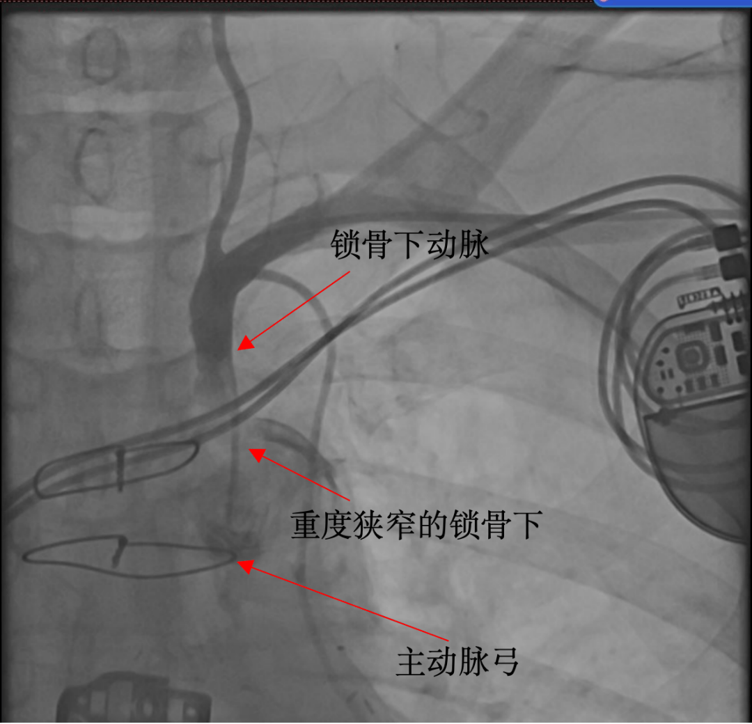 心绞痛反复发作,严重影响患者生活质量,行锁骨下动脉支架植入术治疗1