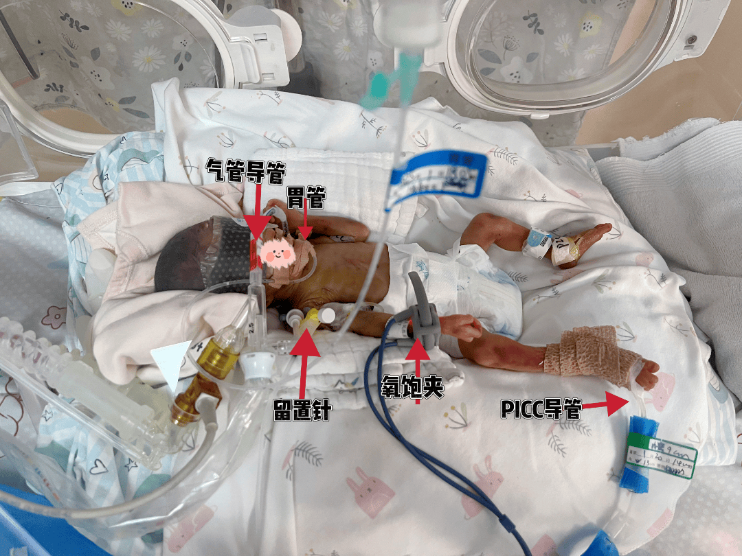 生命奇迹:26周 5天,650克超早产儿在州人民医院成功治愈出院