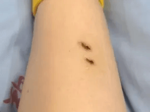 女子在酒店床上被毒蛇咬伤：扎16支血清，住院半月无法站立，时隔两年仍有后遗症
