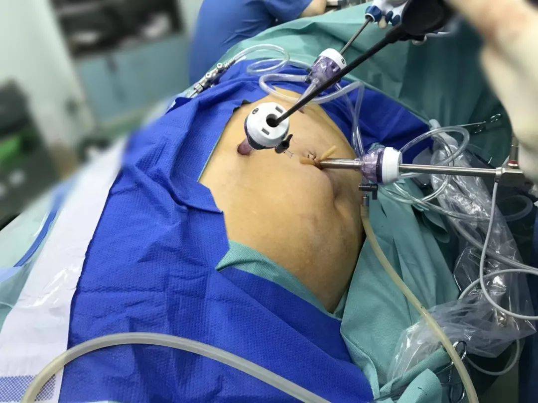 横栏院区首例腹腔镜输尿管成形术实现技术突破