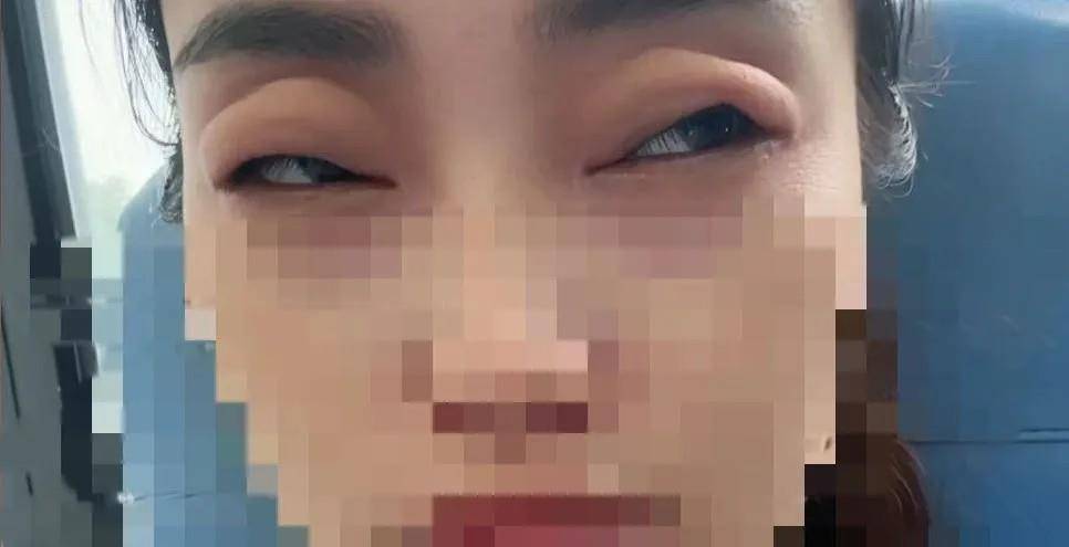 六月“顶流”生果 女子吃完秒变“哀痛蛙” 医师：“稀有却阴险”