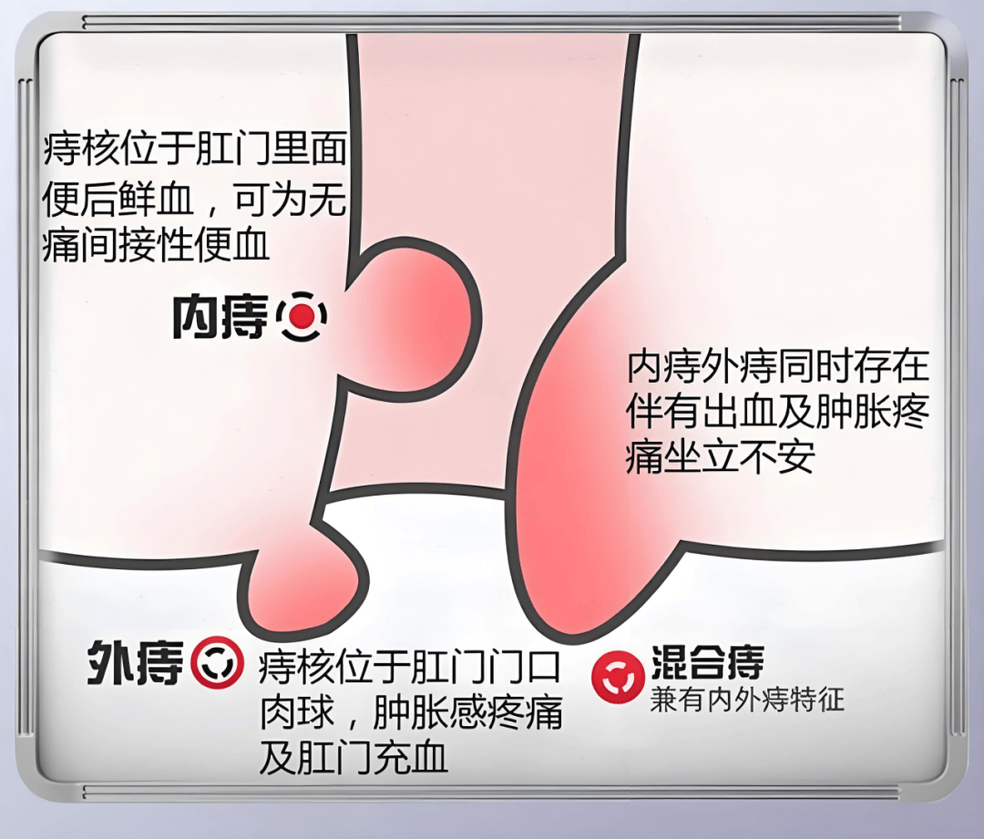 这种痔疮要当心!