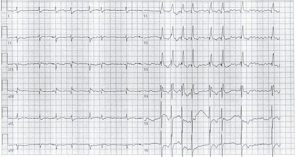 心电图:心房颤动完全性右束支传导阻滞st