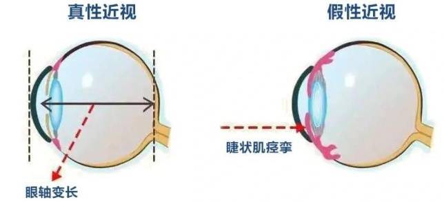 视力突然下降可能是“假的”！护眼“米”字操，让眼睛秒回血→