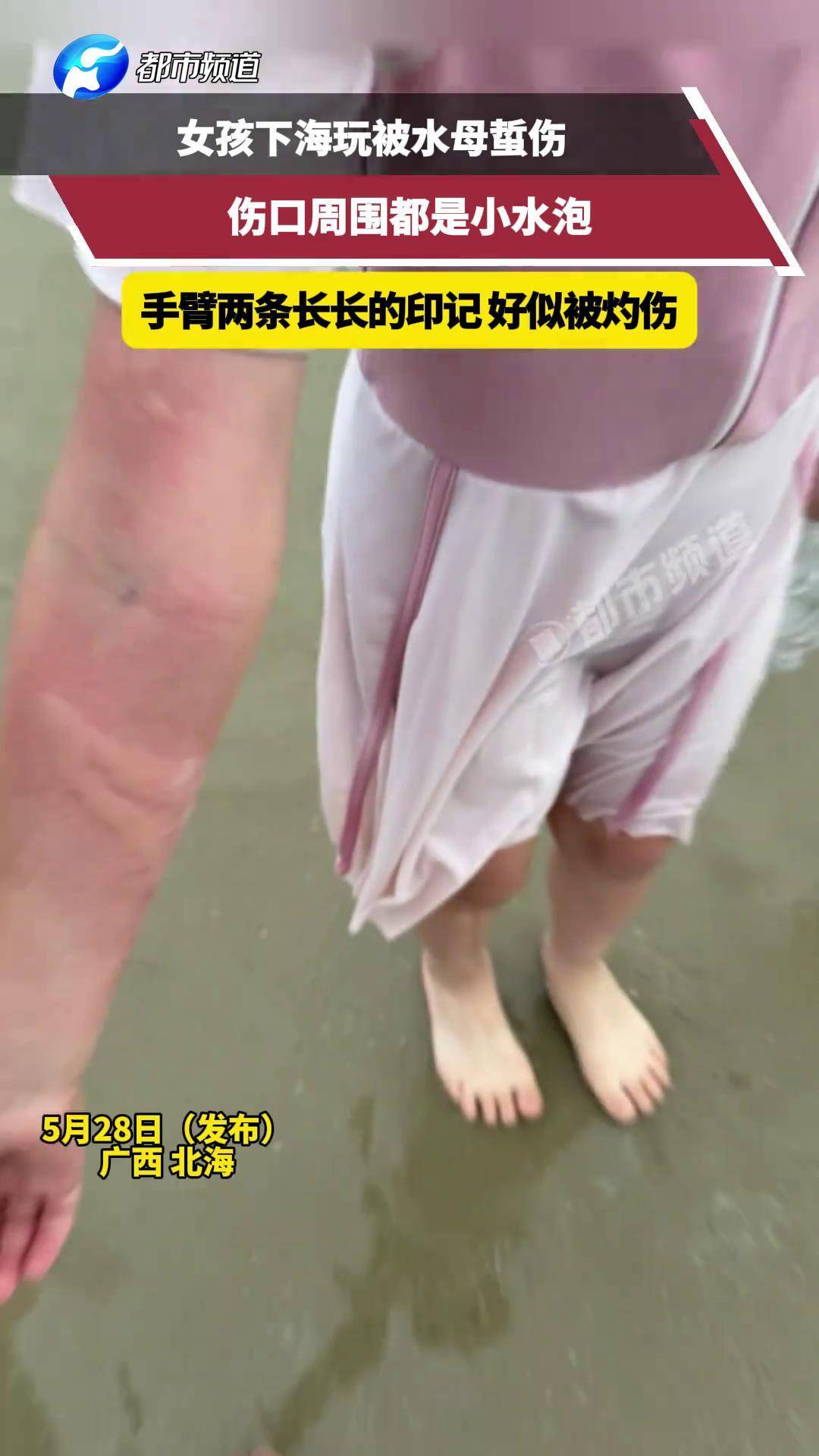ᰔ ᩚ🧚‍️ 下海玩被水母蜇伤,伤口周围都是小水泡,手臂两