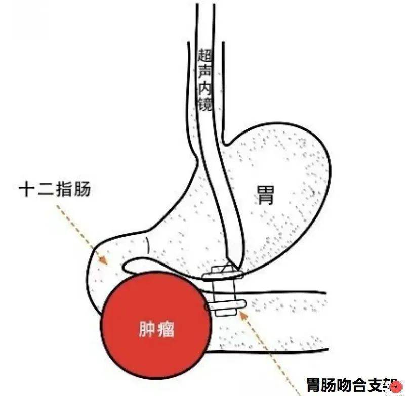 淄博市中心医院西院消化内科开展全市首例超声内镜下胃空肠吻合术