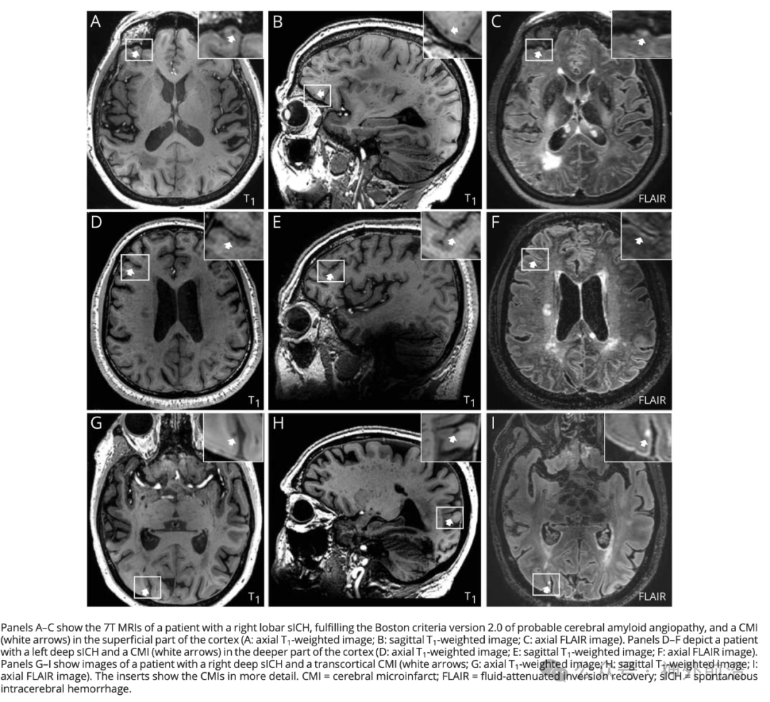 neurology报道通过7t磁共振可发现70%的自发性脑出血患者