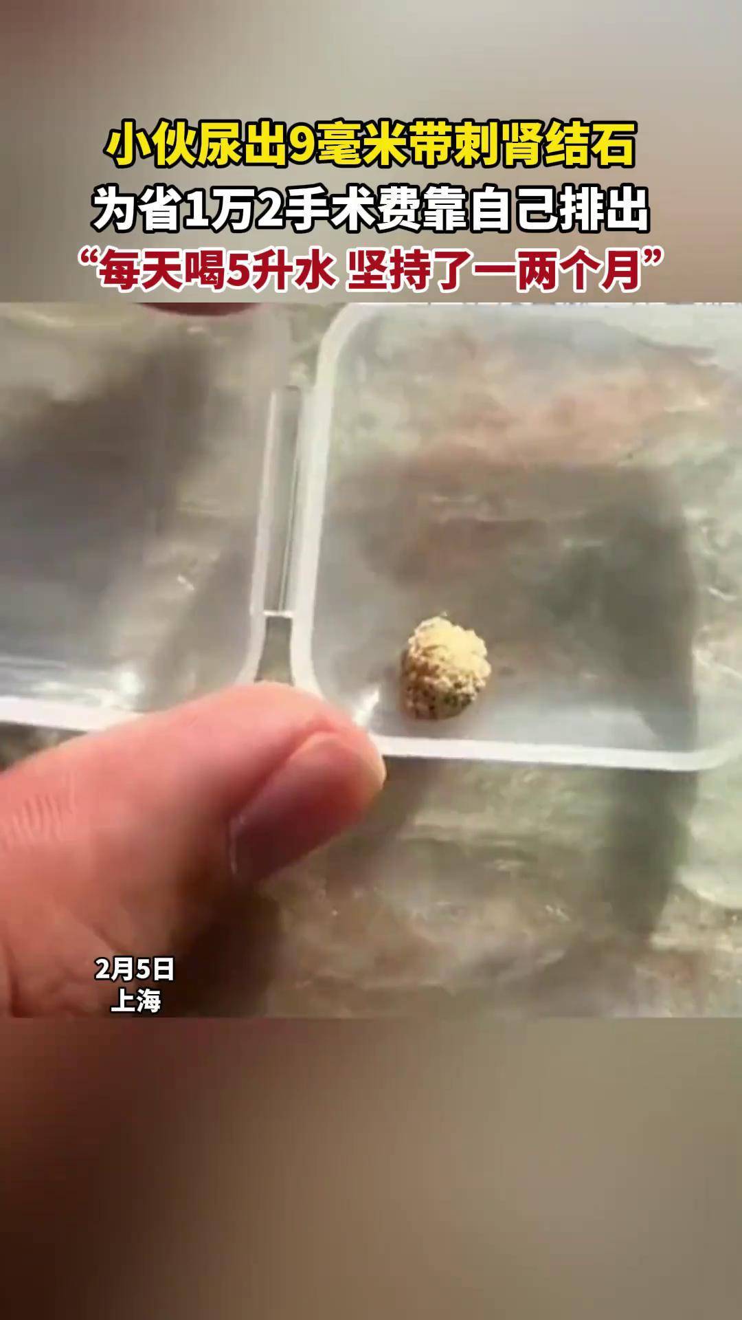 小伙尿出9毫米带刺肾结石,为省1万2手术费靠自己排出,"每天喝5升水