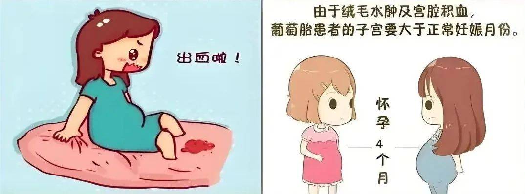 怀孕后肚子里长"葡萄"?揭秘葡萄胎的真相与应对