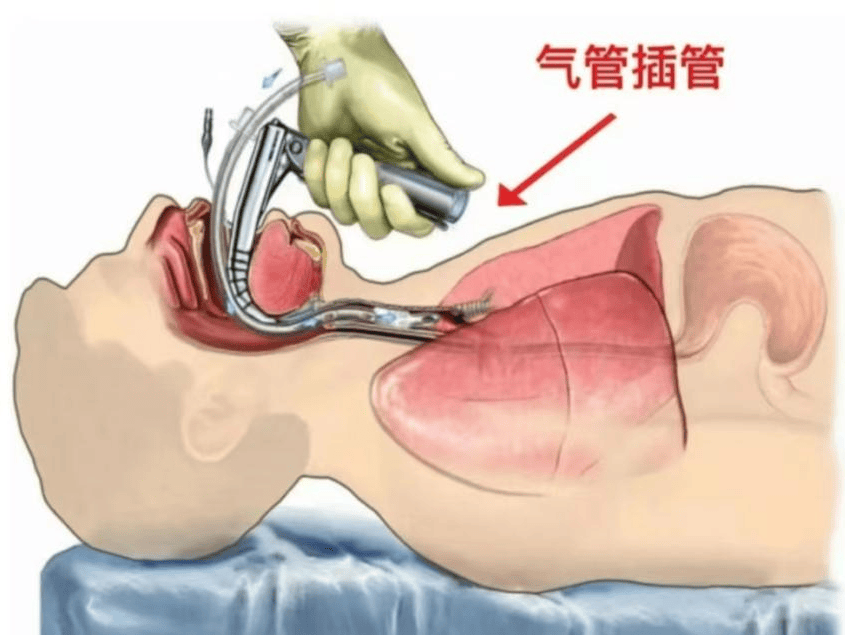 冠县新华医院丨科普 — 重症医学之气管插管知多少?