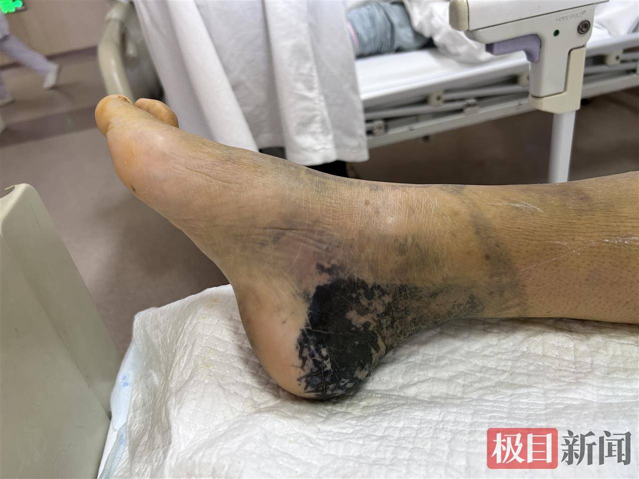 用“知了壳淬白酒”治扭伤	，女子外敷三天后脚踝变青黑