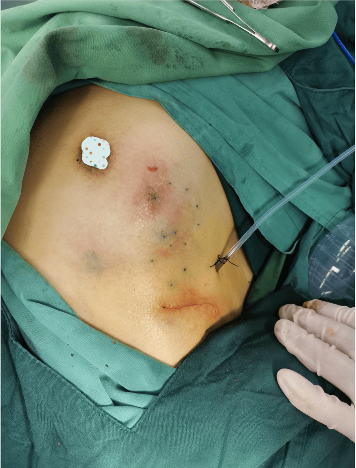 乳腺一科利用微创技术守护患者美丽与健康