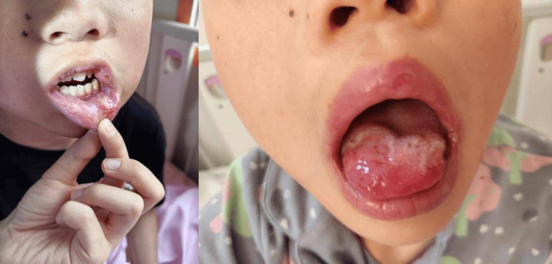重复对孩子的口腔溃疡？照