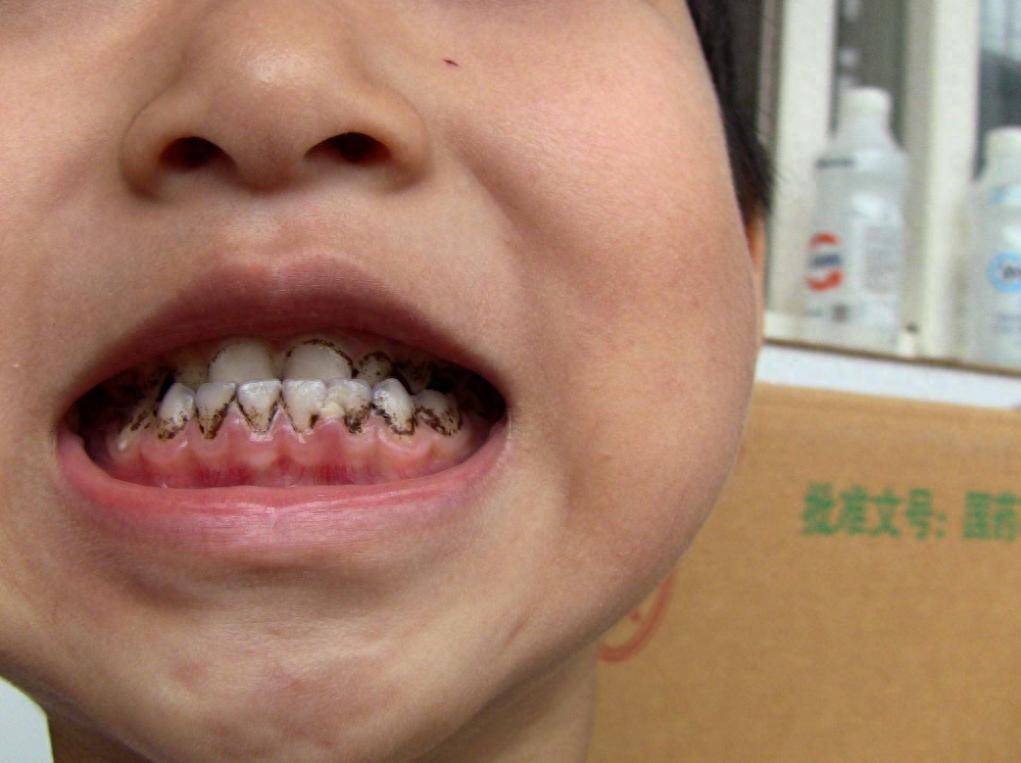 如何预防龋齿?做到"四少吃三多吃三坚持"