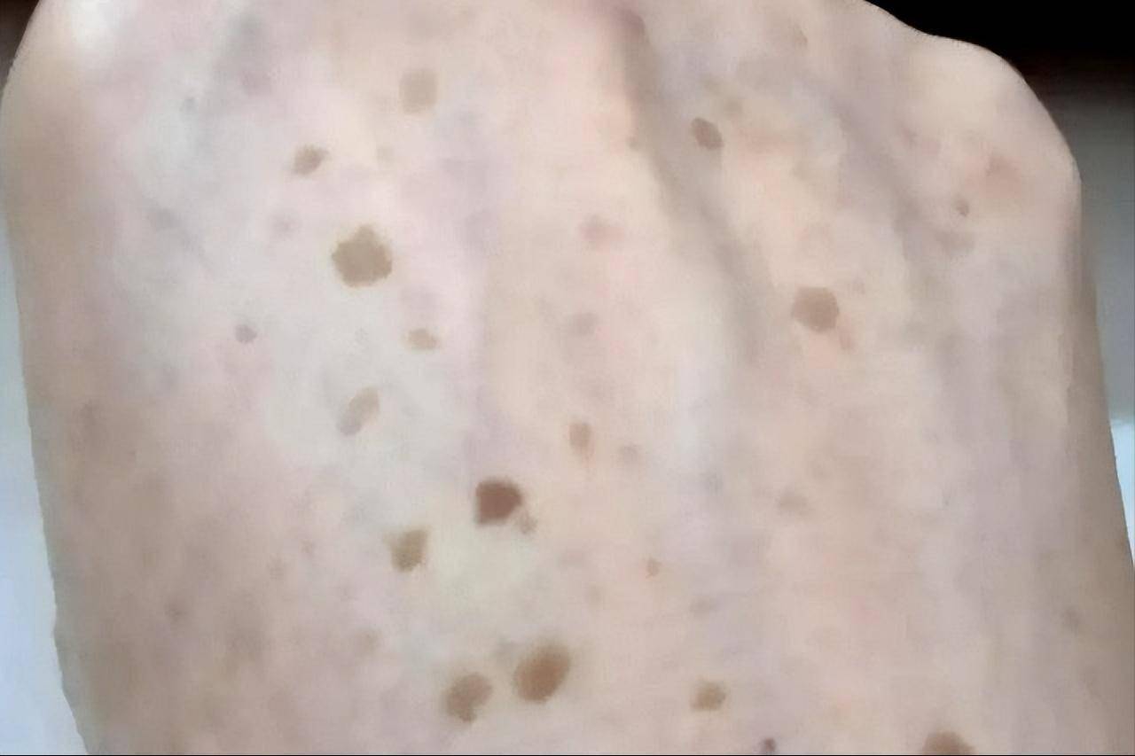 经常长老年斑的人,背后或有这3原因!