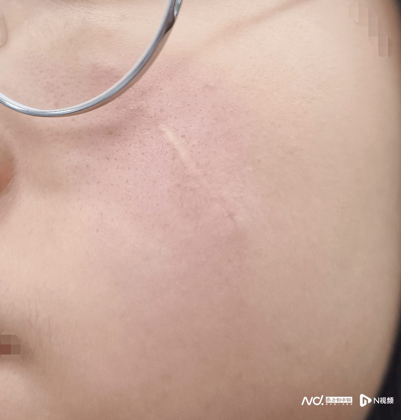 女子在深圳龙岗中心医院整形后留明显疤痕 院方:正常并发症(图2)