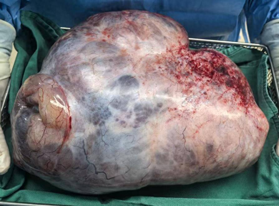 肚子莫名其妙变大,22岁女子因腹痛就医,意外在体内发现一个巨大肿瘤