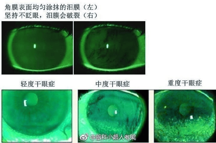 看电脑手机眼睛刺痛，该怎么办?