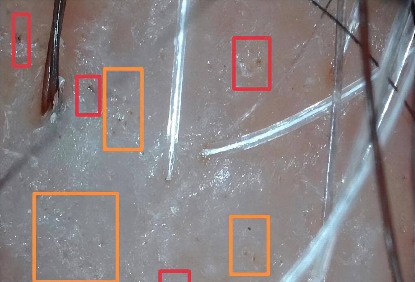 人的头发为什么会变白