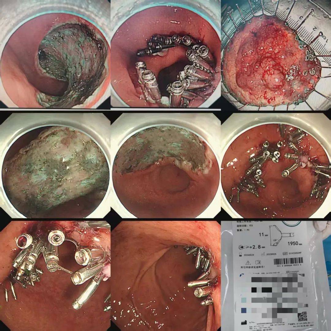 ,内镜全层切除术