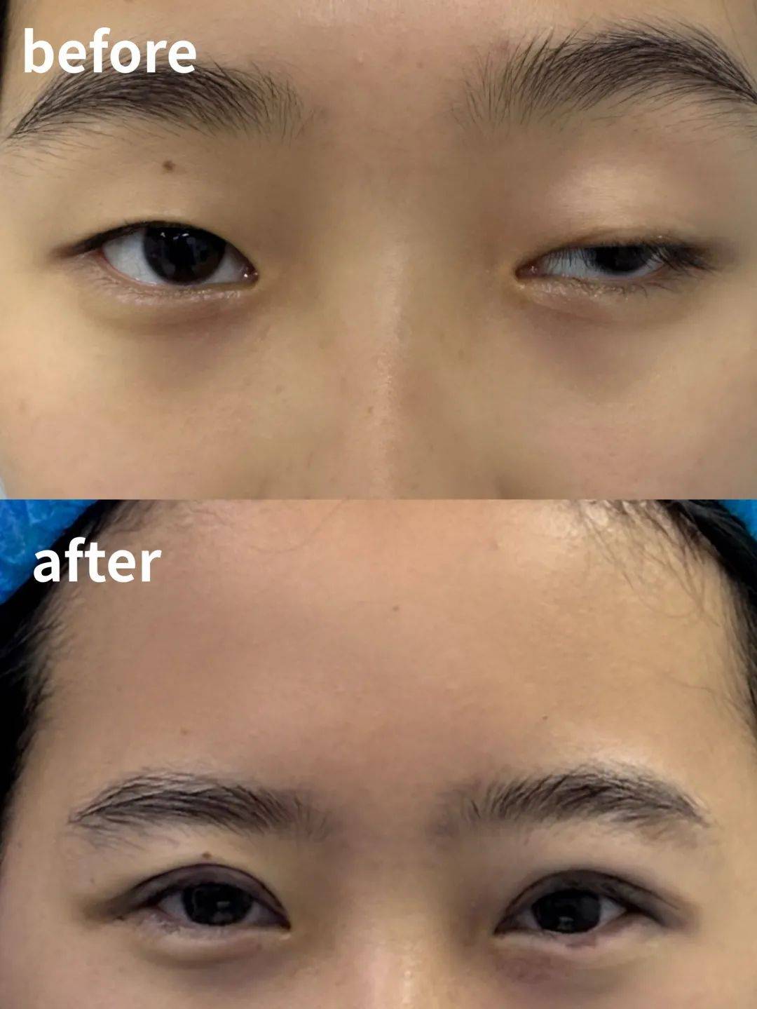 告别无神眼,"上睑下垂"公益矫正限时免费!点击报名