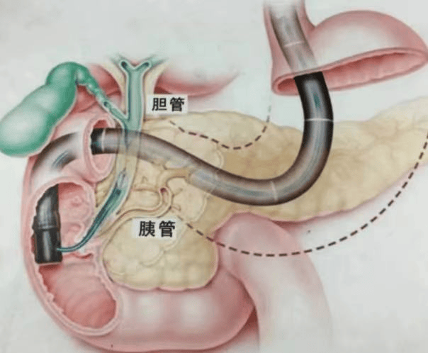 宿迁钟吾医院消化内科引进子镜技术赋能ercp,让胆胰患者告别"盲查盲治