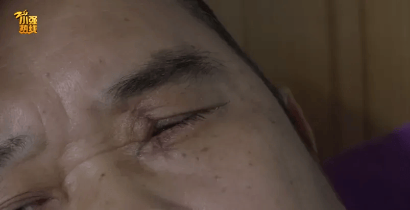 突然炸了！浙江一男子眼球被炸破，元凶是它？夏天不少人会接触