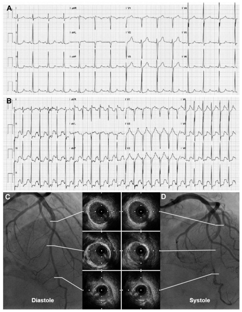 上海中山医院葛均波等提出左前降支心肌桥的葛氏三联征