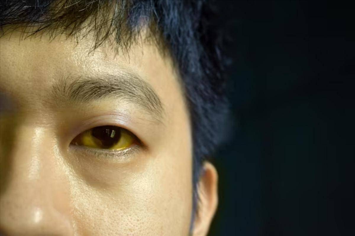 黄疸是其中最容易被肉眼察觉的信号