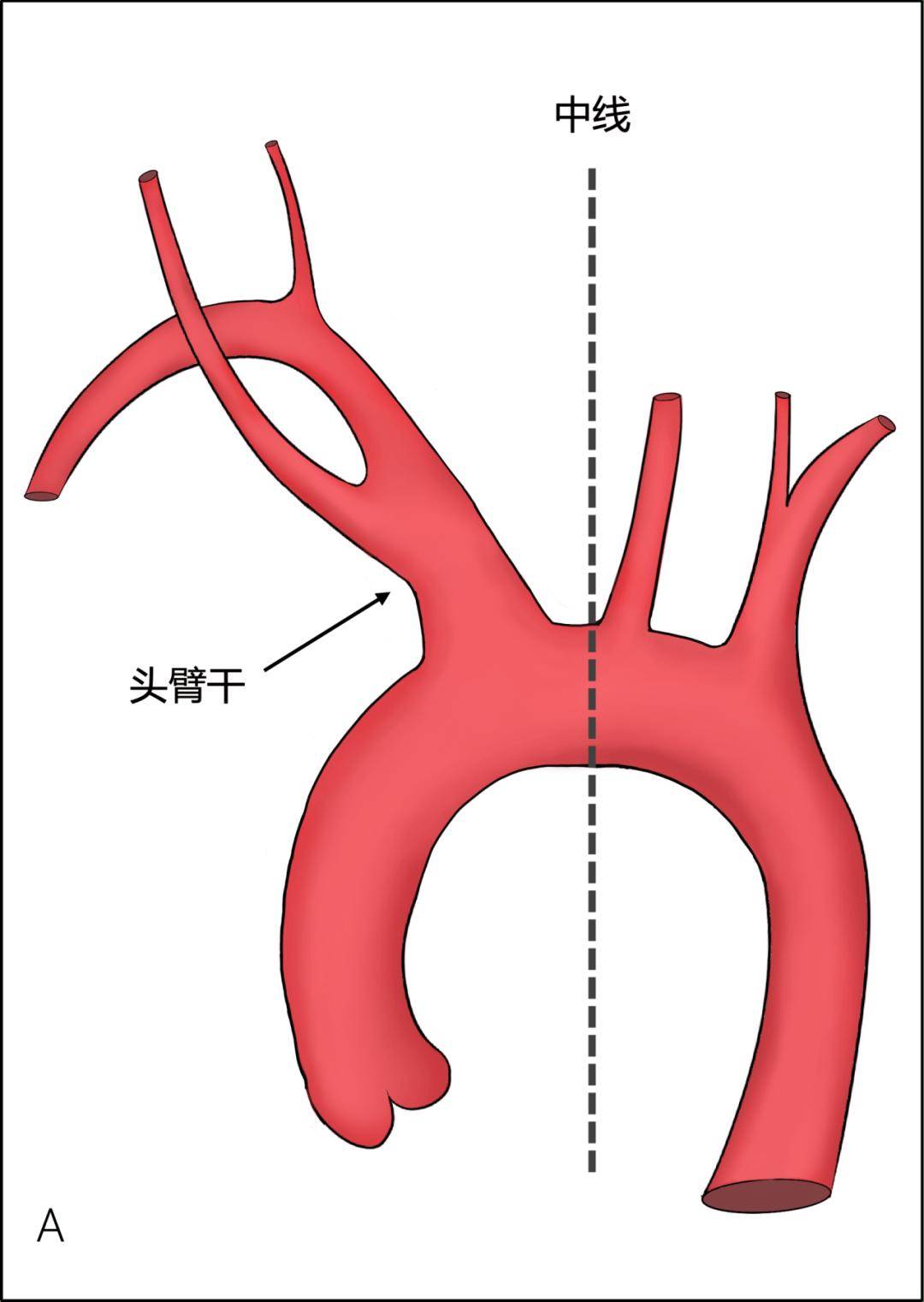 以下为笔者的理解:主要指头臂干起始部偏高,并且更加靠近