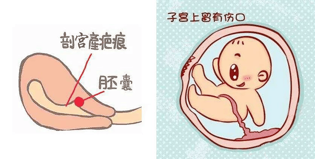 冠县新华医院丨科普早孕雷区瘢痕妊娠