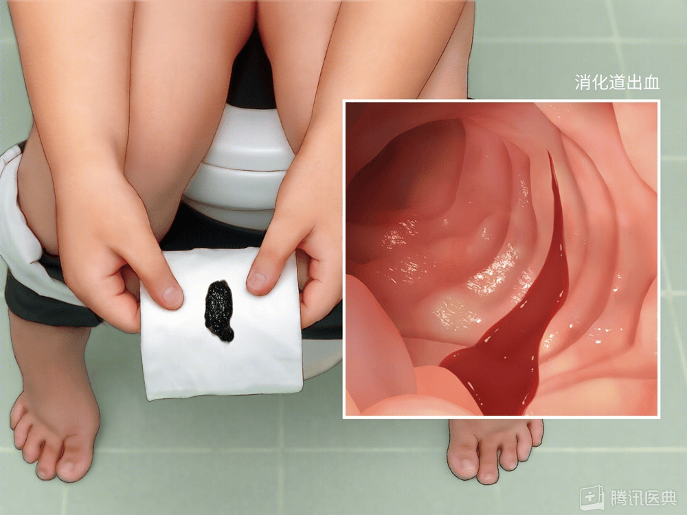 口臭5年,查出胃癌前病变!很多人感染后,没有症状