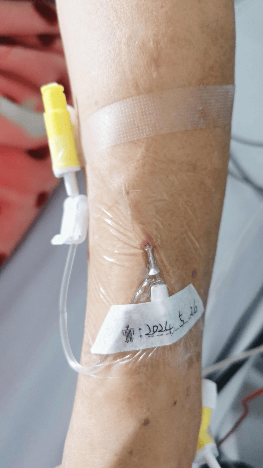 护士关注的留置针问题,答案全在这里了!