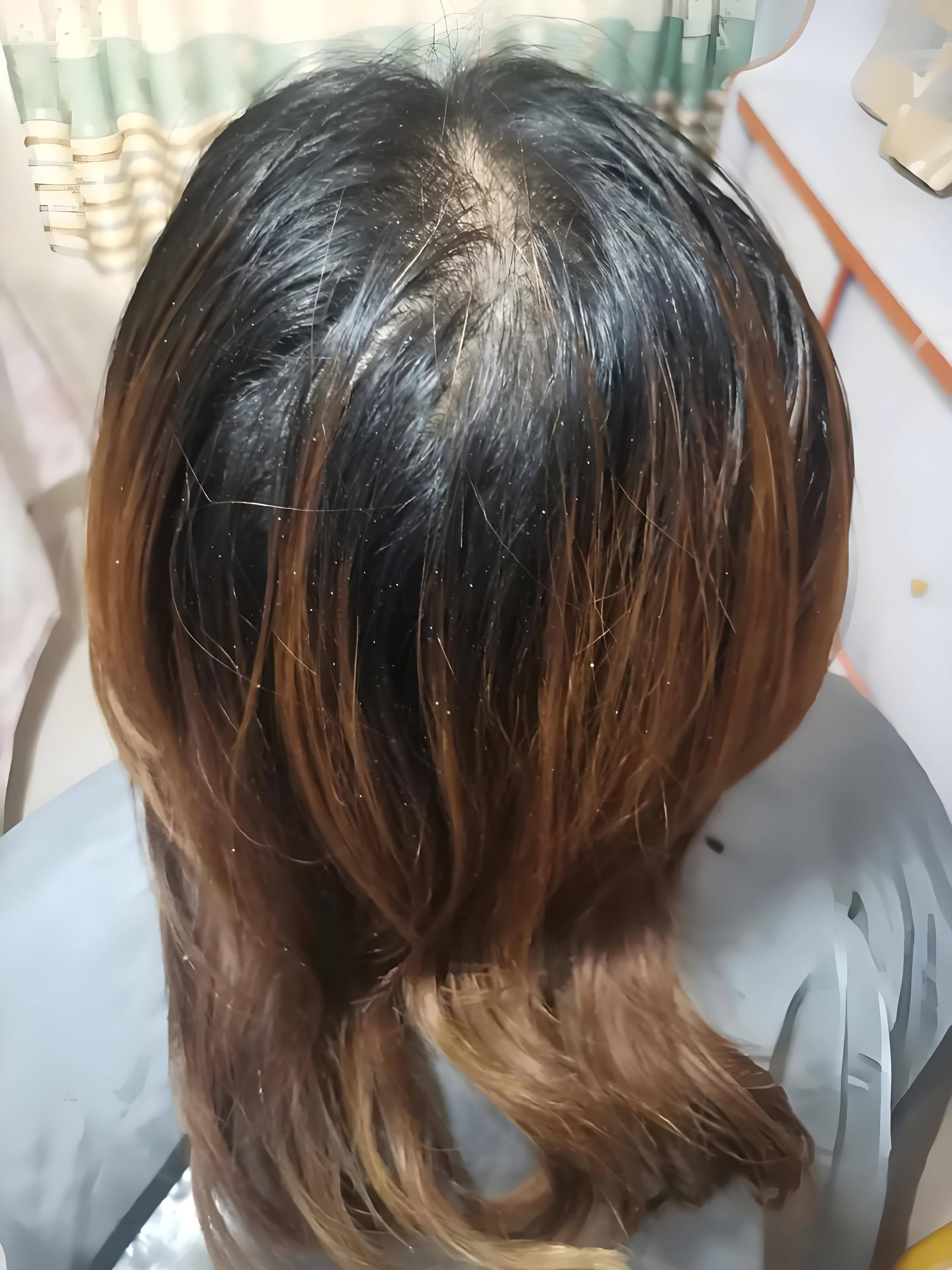 解决油头脱发屑问题